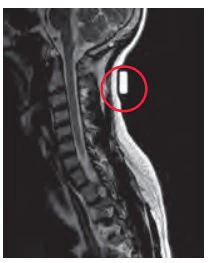 PDC Healthcare Radiology Skin Marker MRI Spee-D-Mark Oblong General Use (40/BX) - Image 2
